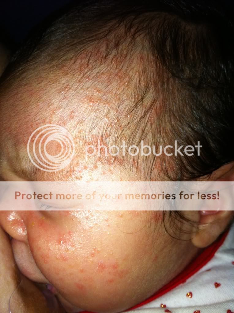 rash on baby face... or acne?? need advice!! pictures Page 2 BabyCenter